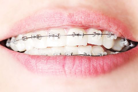 Multibrackets: Drähte ziehen an den Metallklammern und diese kleben an den Zähnen