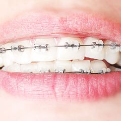 Multibrackets: Drähte ziehen an den Metallklammern und diese kleben an den Zähnen