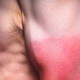 Verwenden Sie je nach Hauttyp Sonnenschutzmittel mit Lichtschutzfaktor 8 bis 20, aber nur in Ausnahmefällen UV-Blocker. Denn UV-Strahlen wirken antientzündlich und verschaffen den meisten Neurodermitikern Linderung