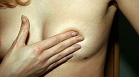 Etwa fünf bis zehn Prozent aller Brust- und Eierstockkrebsfälle sind auf erbliche Faktoren zurückzuführen