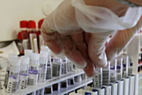 Beim PSA-Test wird die Konzentration des Prostata-spezifischem Antigens im Blut ermittelt. Erhöhte Werte können auf einen Tumor deuten