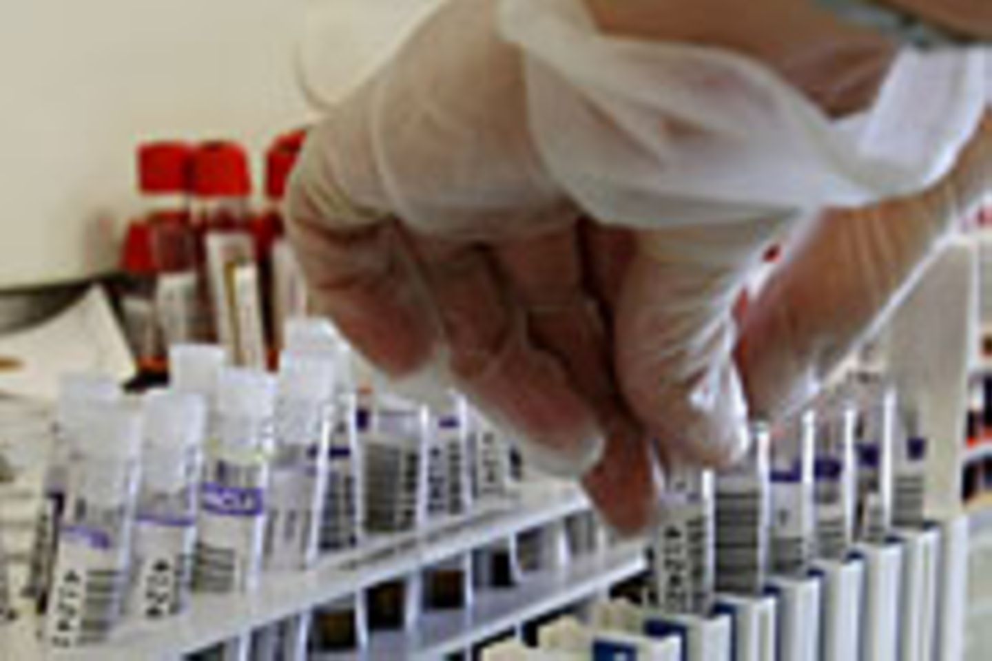 Beim PSA-Test wird die Konzentration des Prostata-spezifischem Antigens im Blut ermittelt. Erhöhte Werte können auf einen Tumor deuten