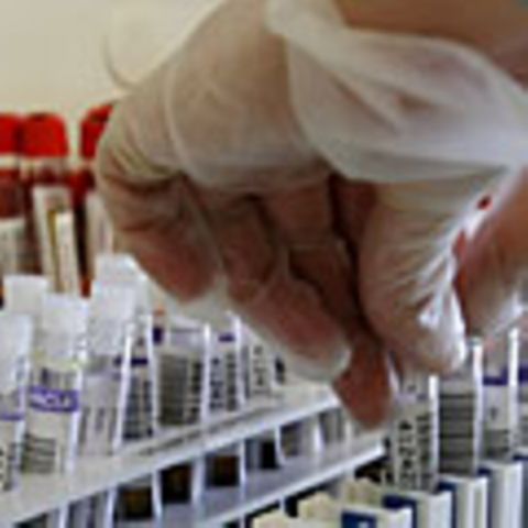 Beim PSA-Test wird die Konzentration des Prostata-spezifischem Antigens im Blut ermittelt. Erhöhte Werte können auf einen Tumor deuten