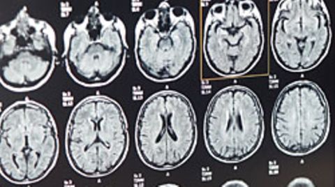 Magnetresonanztomographie-Aufnahmen eines Gehirns
