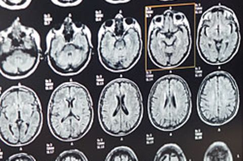 Magnetresonanztomographie-Aufnahmen eines Gehirns