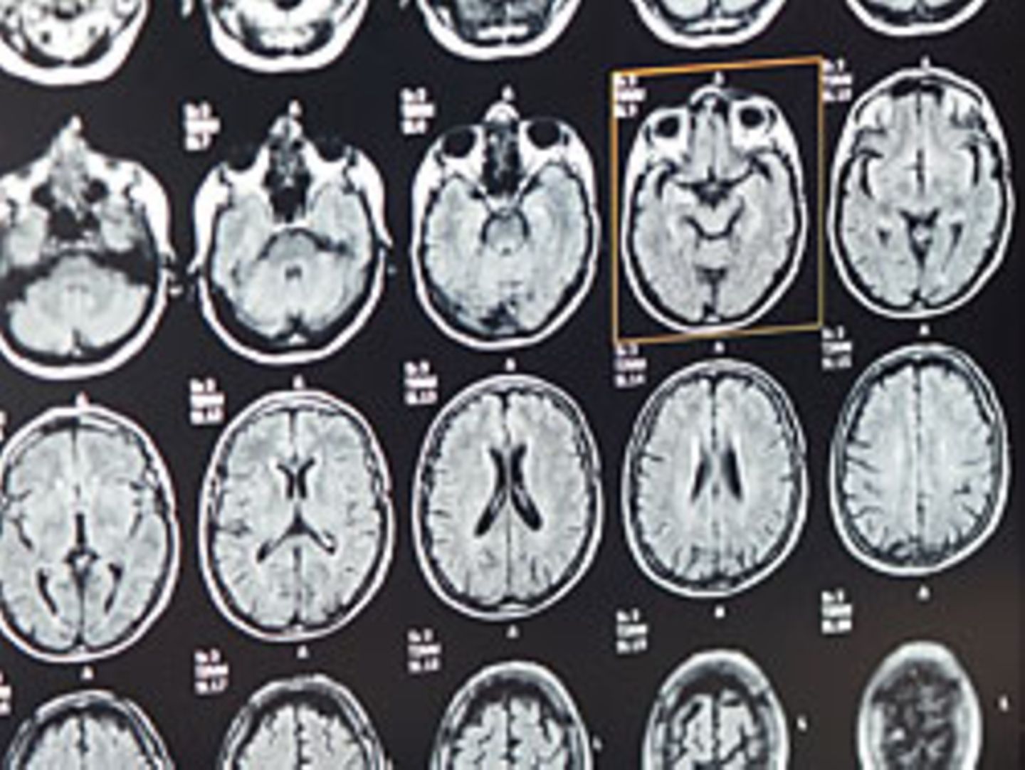 Magnetresonanztomographie-Aufnahmen eines Gehirns