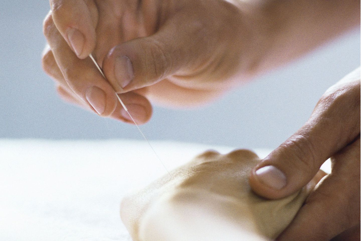 Akupunktur kann bei einer Allergie die schulmedizinische Behandlung ergänzen