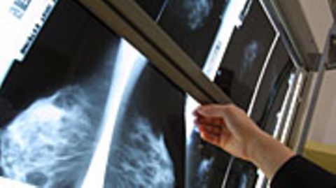 Ein Arzt schaut sich die Ergebnisse der Mammographie an