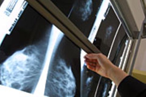 Ein Arzt schaut sich die Ergebnisse der Mammographie an