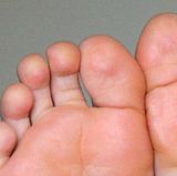 Behandeln Sie Schwielen nicht selbst. Überlassen Sie diese schwierige Arbeit lieber speziell geschulten Fußpflegern, auch Podologen genannt