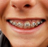 Mit der Munddusche können Sie nach dem Zähneputzen die Zahnzwischenräume noch besser reinigen. Das ist besonders empfehlenswert bei Zahnspangen oder anderen kieferorthopädischen Geräten