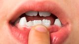 Manche Kinder haben Probleme mit ihren Zähnen oder dem Kiefer. Zahnlücken können extrem groß sein, Zähne nicht genug Platz haben. Oder der Unterkiefer ist seitlich, nach vorn oder nach hinten verschoben. Der Zahnarzt berät Sie, ob und wann eine kieferorthopädische Behandlung mit einer Spange oder anderen Apparaturen sinnvoll ist.