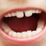 Kontrollieren Sie auch in den ersten Schuljahren regelmäßig die Zähne Ihres Kindes. Schauen Sie dabei vor allem auf die sogenannten Sechsjahr-Molaren. Diese ersten bleibenden Backenzähne sind aufgrund der Rillen in den Kauflächen besonders anfällig für Karies.