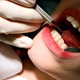 Auch wenn Sie Ihre Zähne immer gründlich reinigen, können Sie nicht verhindern, dass sich Zahnstein bildet. Solche Verkrustungen werden bei einer professionelle Zahnreinigung entfernt. Zweimal im Jahr sollten Sie sich dieser Prozedur unterziehen