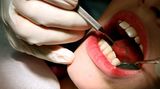 Auch wenn Sie Ihre Zähne immer gründlich reinigen, können Sie nicht verhindern, dass sich Zahnstein bildet. Solche Verkrustungen werden bei einer professionelle Zahnreinigung entfernt. Zweimal im Jahr sollten Sie sich dieser Prozedur unterziehen