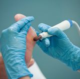 Behandeln Sie nicht Ihre Hühneraugen nicht selbst, sondern gehen Sie lieber zur medizinischen Fußpflege: Das Personal dort sollte sich mit Füßen von Patienten mit Diabetes auskennen