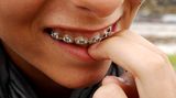 Unter festen Zahnspangen bleiben leicht Speisereste hängen. Sollte Ihr Kind also eine Spange oder eine andere Gebisskorrektur tragen, achten Sie ganz besonders auf regelmäßiges und gründliches Zähneputzen.