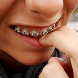 Unter festen Zahnspangen bleiben leicht Speisereste hängen. Sollte Ihr Kind also eine Spange oder eine andere Gebisskorrektur tragen, achten Sie ganz besonders auf regelmäßiges und gründliches Zähneputzen.