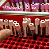 Ob Ihre Niere noch in Ordnung ist, kann der Arzt anhand der Kreatininwerte im Blut ablesen und im Urin erkennen. Lassen Sie Ihre Kreatininwerte einmal im Jahr überprüfen