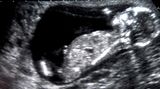 Zu Beginn einer Schwangerschaft sollten Sie Ihre Zähne und Ihr Zahnfleisch vom Arzt kontrollieren und gegebenenfalls behandeln lassen. Danach können Sie weiter zur Vorsorge gehen, sollten aber möglichst größere Eingriffe vermeiden. Zähneziehen oder das Einsetzen von Kronen und Brücken schieben Sie also besser auf