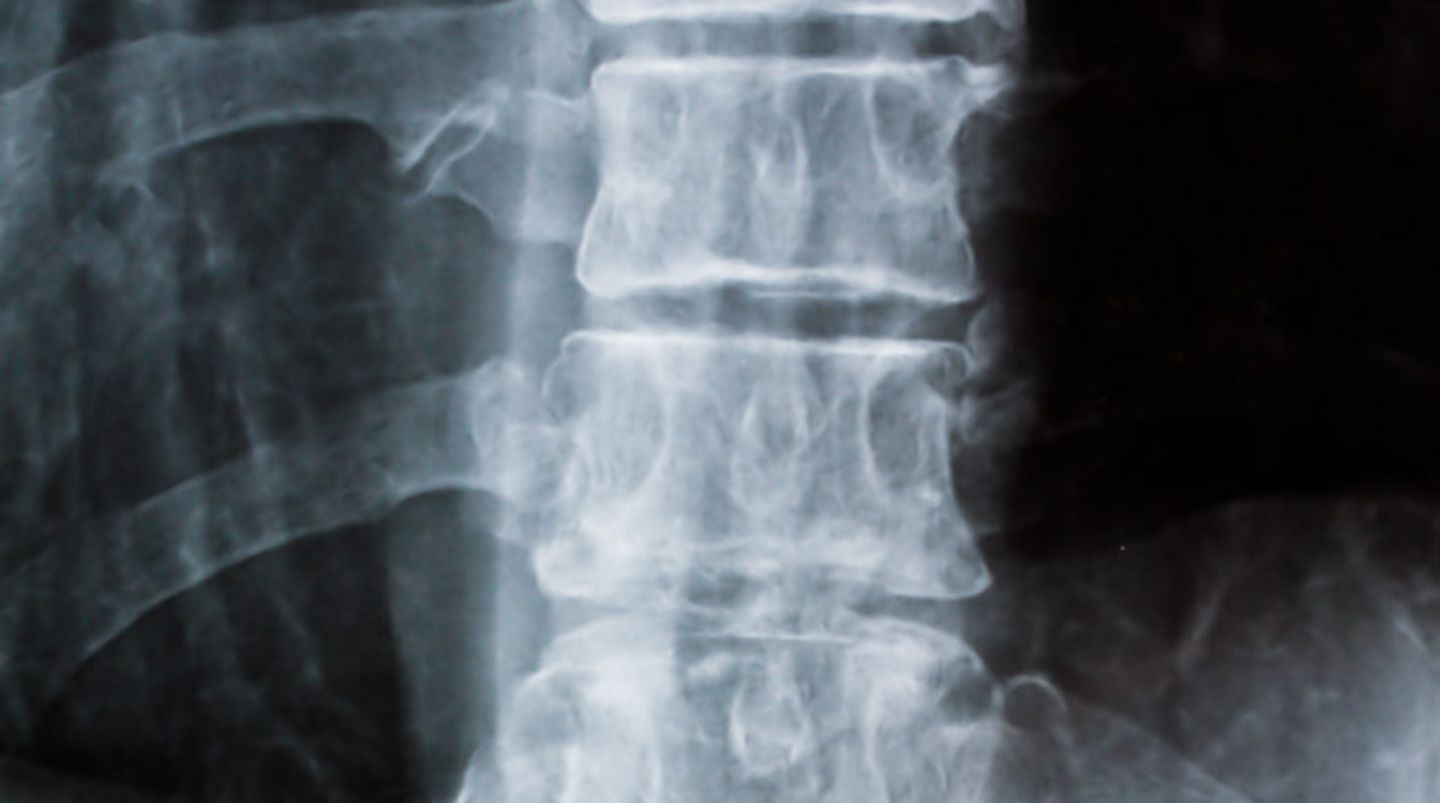Platz 9: ein Arzt    Jede ärztliche Diagnose, sei sie auch noch so unerheblich, verstärkt das Problem: Der Rückenschmerz setzt sich fest - schließlich hat der Arzt ja etwas gefunden.  Wie gut kennen Sie sich mit Ihrem Rücken aus? Ihr Wissen können Sie hier testen