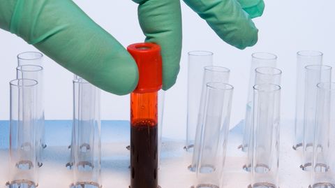 Bislang konnten Blutproben nur auf ein bestimmtes Virus hin untersucht werden. Ein neuer Test fahndet nach Hunderten Antikörpern.