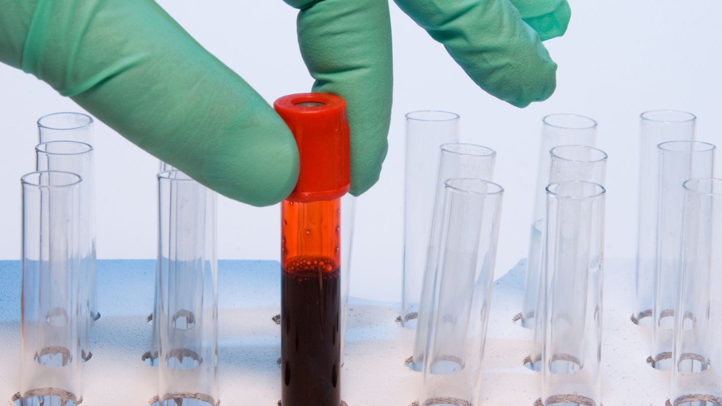 Bislang konnten Blutproben nur auf ein bestimmtes Virus hin untersucht werden. Ein neuer Test fahndet nach Hunderten Antikörpern.