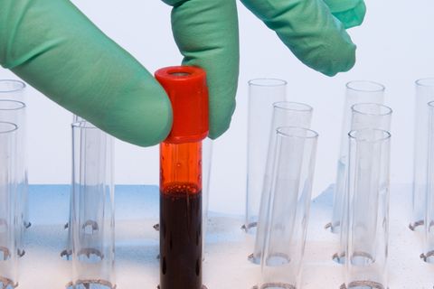 Bislang konnten Blutproben nur auf ein bestimmtes Virus hin untersucht werden. Ein neuer Test fahndet nach Hunderten Antikörpern.