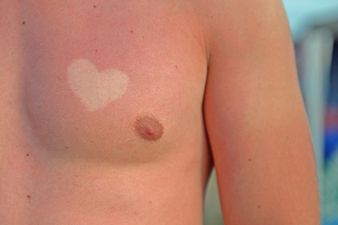 Was sich hier zum Trend zu entwickeln droht, ist roher Wahnsinn: "Sunburn Art".