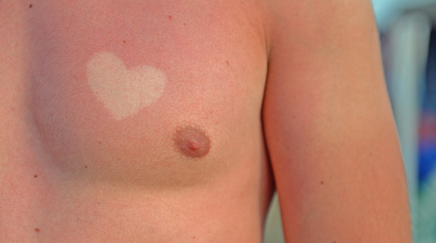 Was sich hier zum Trend zu entwickeln droht, ist roher Wahnsinn: "Sunburn Art".