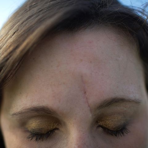 Eine lange Narbe verläuft neben dem Nasenbein von der Augenbraue bis in die Stirn einer jungen Frau. Ihre Augen sind geschlossen
