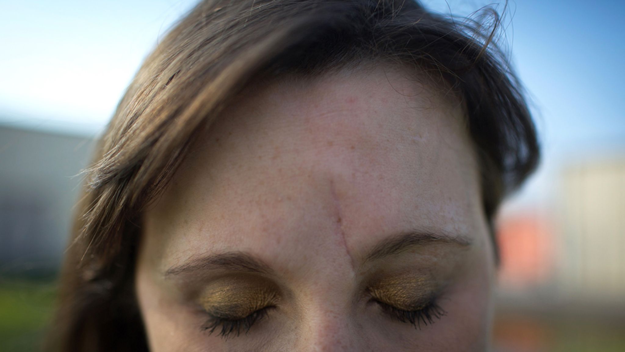 Eine lange Narbe verläuft neben dem Nasenbein von der Augenbraue bis in die Stirn einer jungen Frau. Ihre Augen sind geschlossen