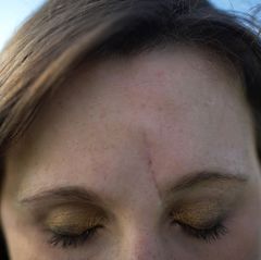 Eine lange Narbe verläuft neben dem Nasenbein von der Augenbraue bis in die Stirn einer jungen Frau. Ihre Augen sind geschlossen