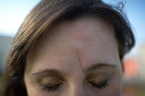Eine lange Narbe verläuft neben dem Nasenbein von der Augenbraue bis in die Stirn einer jungen Frau. Ihre Augen sind geschlossen