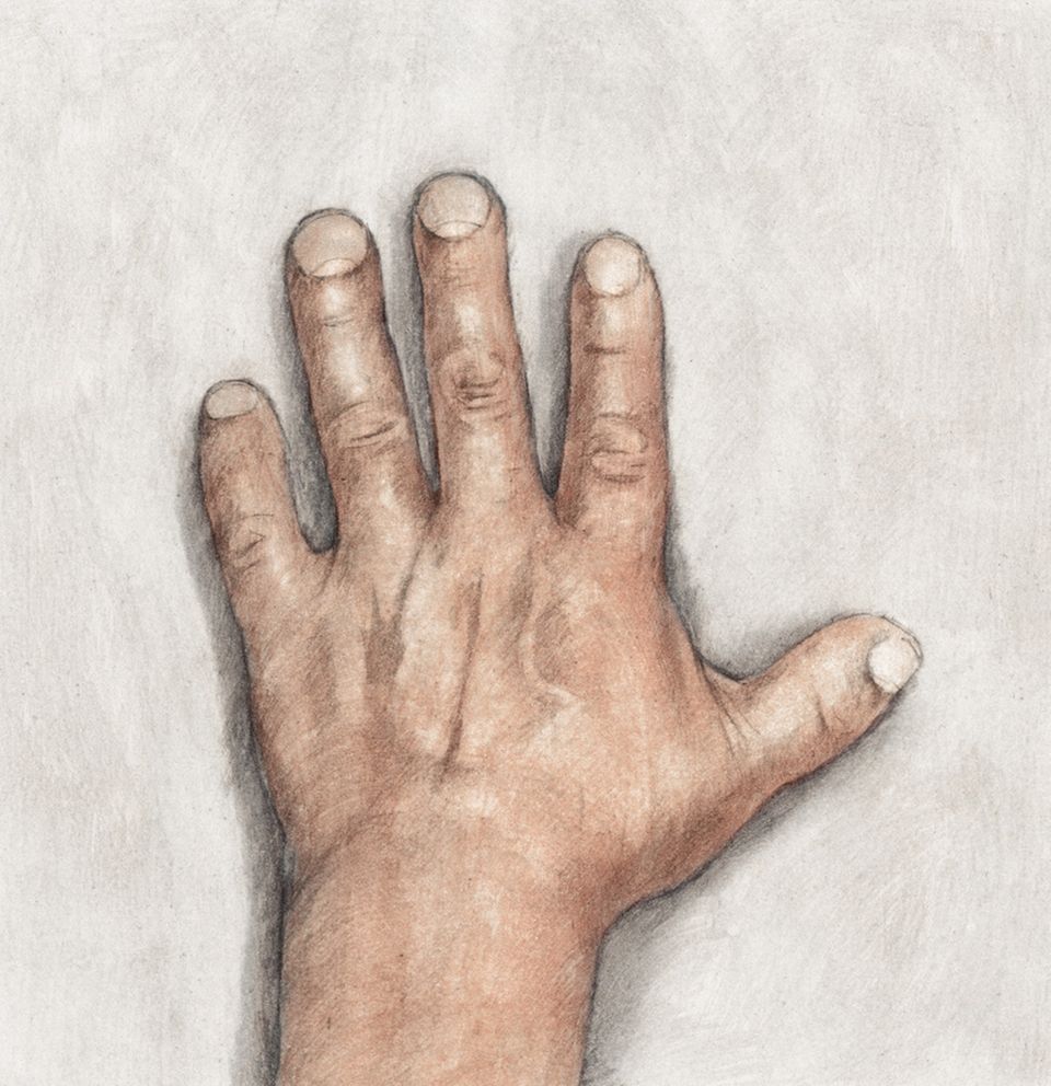 Ein Medizin-Krimi: Die Lösung des Rätsels um die kurzen Finger eröffnet jetzt Chancen für neue Therapien der Volkskrankheit Bluthochdruck. Die Lösung des Rätsels um die kurzen Finger eröffnet jetzt Chancen für neue Therapien der Volkskrankheit Bluthochdruck.