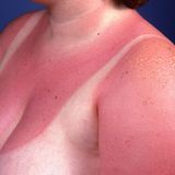 Sonnenbrand