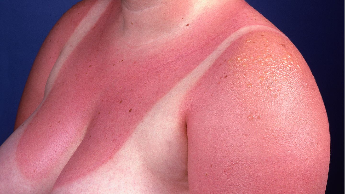 Sonnenbrand Sonnenbrand