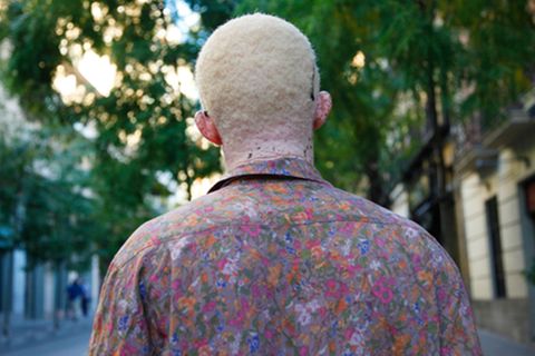 Albinismus in Afrika: Abdul Coulibaly von hinten