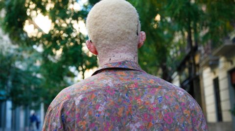Albinismus in Afrika: Abdul Coulibaly von hinten
