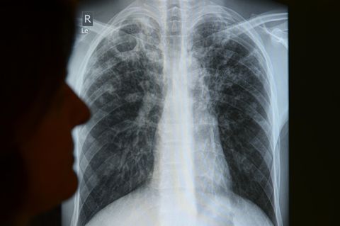 Im Berliner Tuberkulose-Zentrum wird die Röntgenaufnahme eines Patienten ausgewertet.