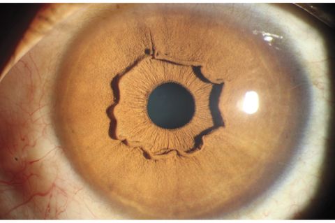 Auge mit auffälliger Iriskrause