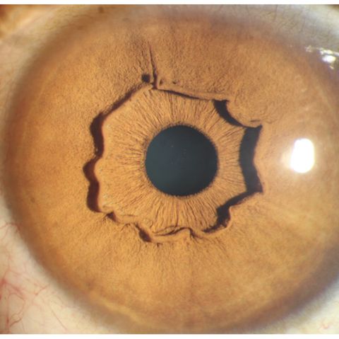 Auge mit auffälliger Iriskrause