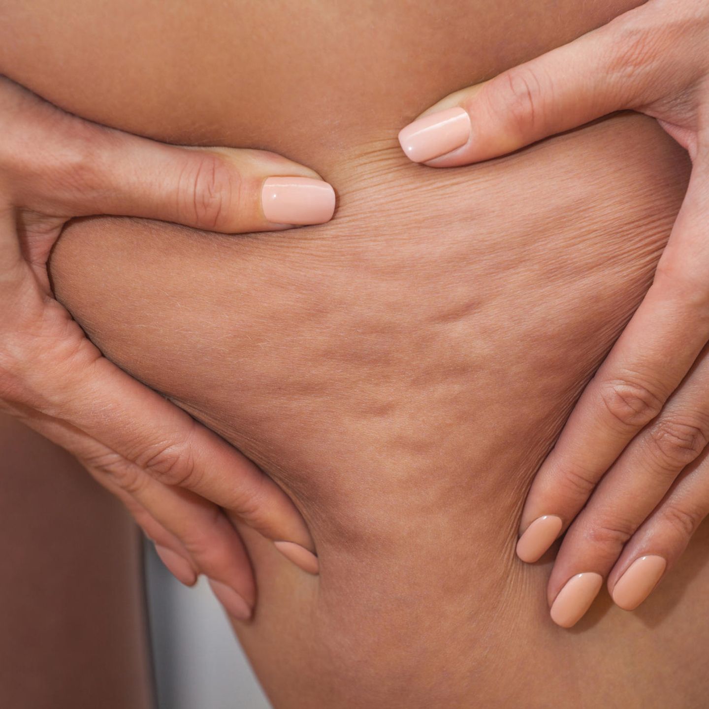 Cellulite Wer Sie Bekommt Und Was Dagegen Hilft Stern De