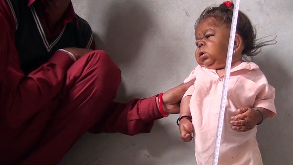 Mysteriöse Wachstumsstörung: Das ist ein erwachsener Mann und kein Baby Mysteriöse Wachstumsstörung: Das ist ein erwachsener Mann und kein Baby