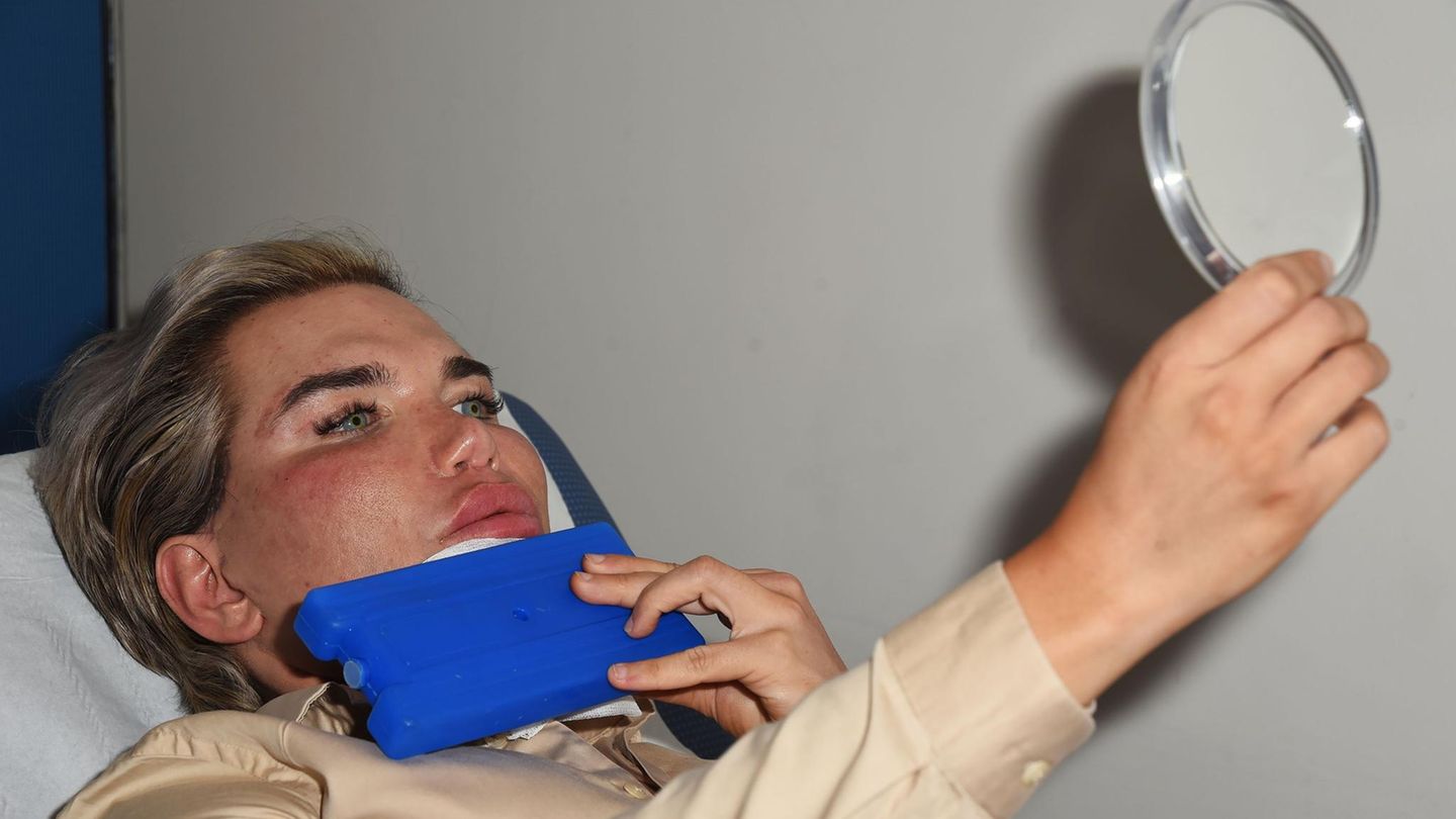 Ken-Doppelgänger Rodrigo Alves lässt sich von Dr Deniz Kanliada in London das Gesicht unterspritzen