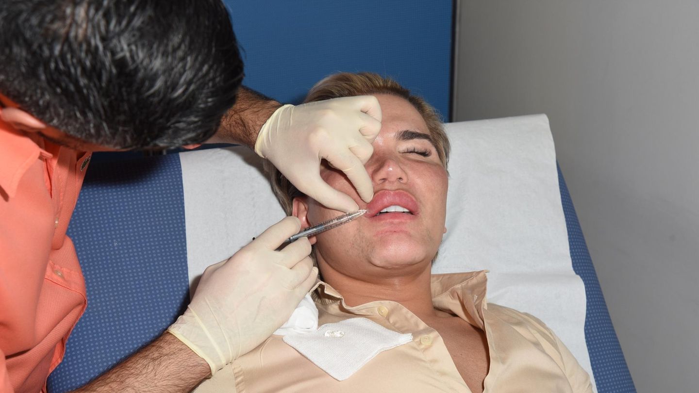 Ken-Doppelgänger Rodrigo Alves lässt sich von Dr Deniz Kanliada in London das Gesicht unterspritzen Ken-Doppelgänger Rodrigo Alves lässt sich von Dr Deniz Kanliada in London das Gesicht unterspritzen