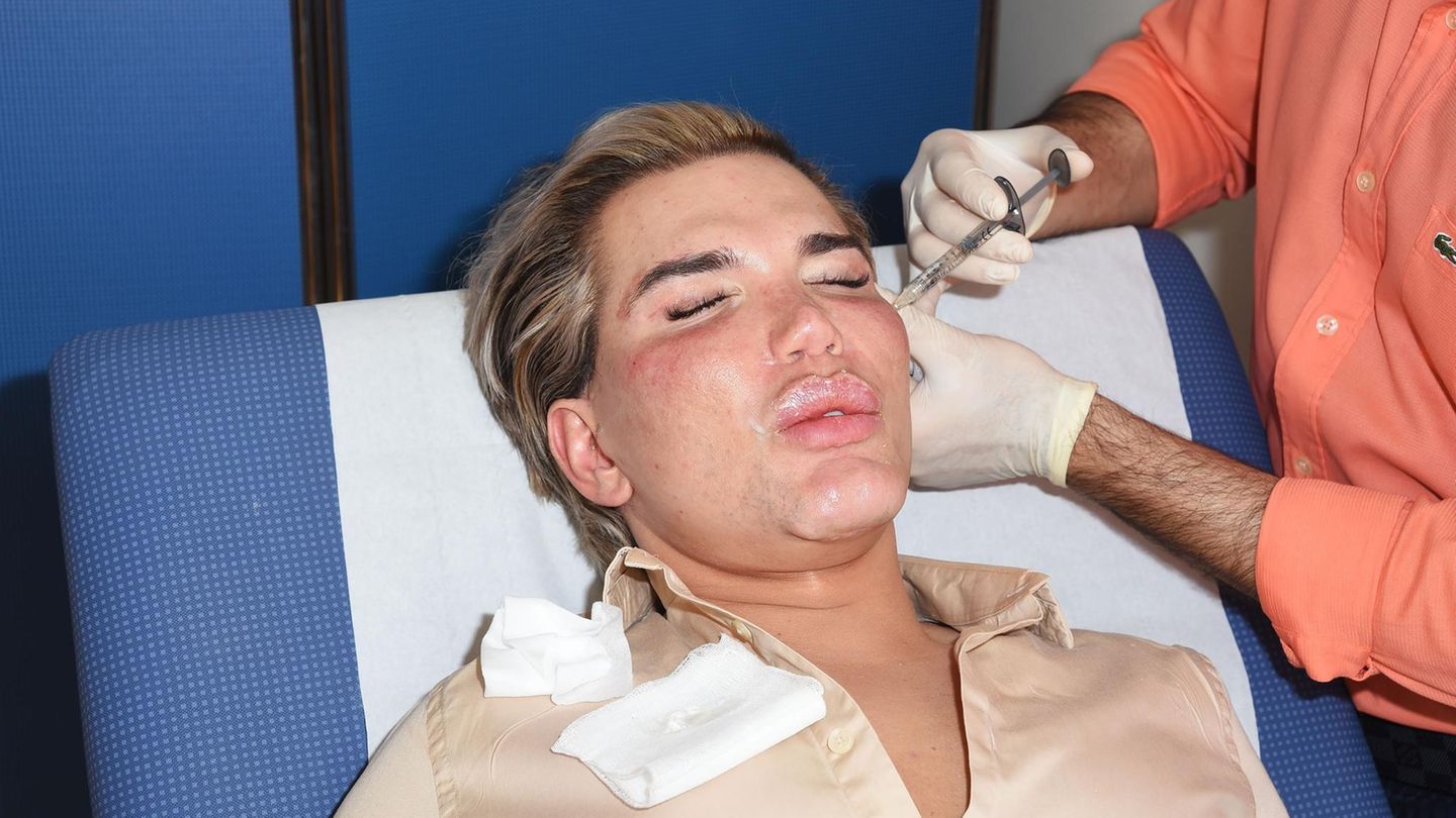 Ken-Doppelgänger Rodrigo Alves lässt sich von Dr Deniz Kanliada in London das Gesicht unterspritzen