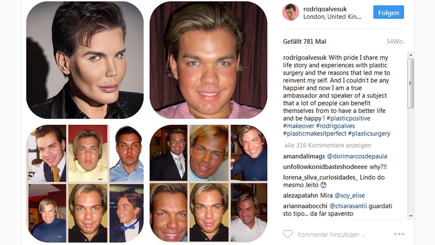 Schönheitswahn: Auf Instagram dokumentiert Alves seine unheimliche Verwandlung vom pausbäckigen Jugendlichen zum menschlichen Ken. "Ich könnte nicht glücklicher sein", schreibt der vom Schönheitswahn besessene Alves dazu. Wer allerdings die Leiden, die hinter den vielen Operationen stecken, sieht, bekommt Zweifel. Auf Instagram dokumentiert Alves seine unheimliche Verwandlung vom pausbäckigen Jugendlichen zum menschlichen Ken. "Ich könnte nicht glücklicher sein", schreibt der vom Schönheitswahn besessene Alves dazu. Wer allerdings die Leiden, die hinter den vielen Operationen stecken, sieht, bekommt Zweifel.