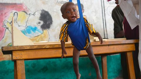 Ein unterernährtes Kind wird von Mitarbeitern eines durch Unicef finanzierten Hilfsprogramms in Somalia gewogen