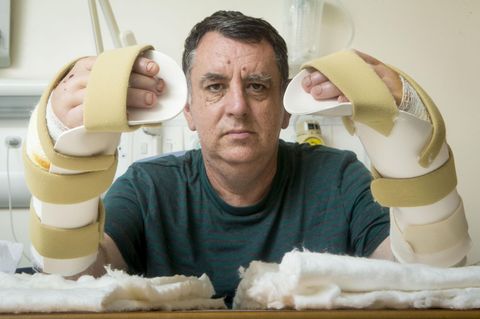 Der Brite Chris King (57) schrieb Geschichte: Als erster Patient in Großbritannien erhielt er im Juli 2016 gleich zwei Spenderhände. King hatte große Teile seiner Hände bei einem Arbeitsunfall mit einer Metallpressmaschine verloren. Nur seine Daumen blieben bei dem Unglück verschont.
